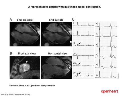 A representative patient with dyskinetic apical contraction.