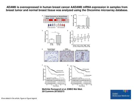 ADAM8 is overexpressed in human breast cancer AADAM8 mRNA expression in samples from breast tumor and normal breast tissue was analyzed using the Oncomine.