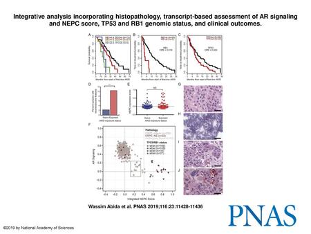 Integrative analysis incorporating histopathology, transcript-based assessment of AR signaling and NEPC score, TP53 and RB1 genomic status, and clinical.