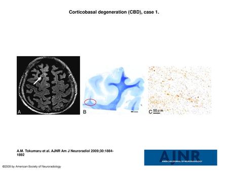 Corticobasal degeneration (CBD), case 1.