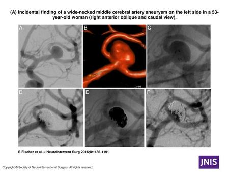 (A) Incidental finding of a wide-necked middle cerebral artery aneurysm on the left side in a 53-year-old woman (right anterior oblique and caudal view).