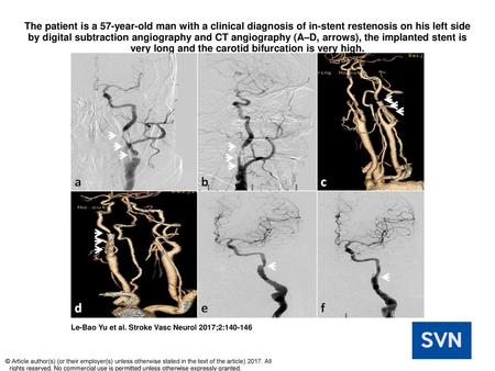 The patient is a 57-year-old man with a clinical diagnosis of in-stent restenosis on his left side by digital subtraction angiography and CT angiography.