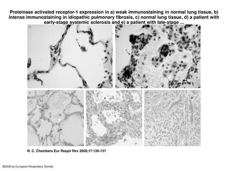 Proteinase activated receptor-1 expression in a) weak immunostaining in normal lung tissue, b) intense immunostaining in idiopathic pulmonary fibrosis,