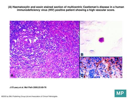 (A) Haematoxylin and eosin stained section of multicentric Castleman's disease in a human immunodeficiency virus (HIV) positive patient showing a high.