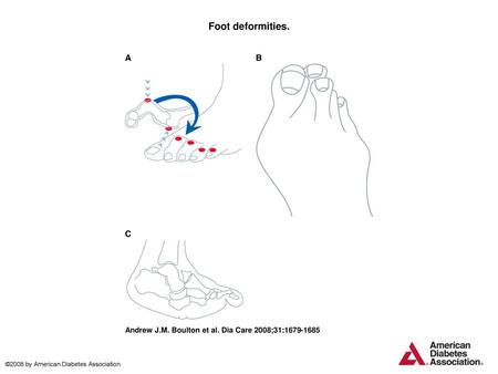 Foot deformities. Foot deformities. These sites are frequent locations for diabetic foot ulceration. A: Claw toe deformity. Note the buckling phenomenon.