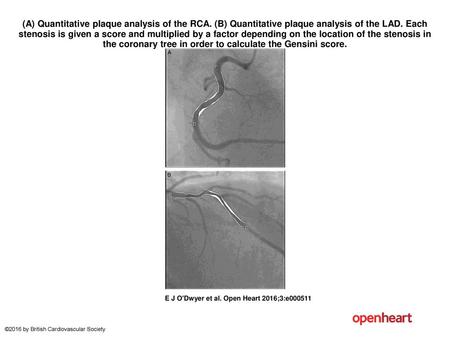 (A) Quantitative plaque analysis of the RCA