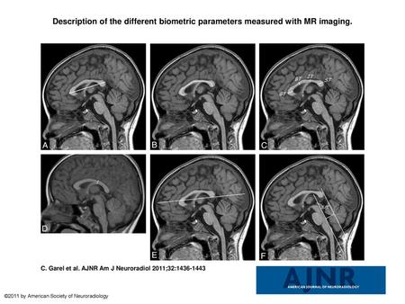 Description of the different biometric parameters measured with MR imaging. Description of the different biometric parameters measured with MR imaging.