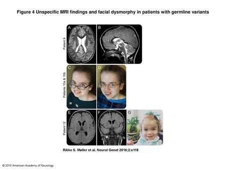 Figure 4 Unspecific MRI findings and facial dysmorphy in patients with germline variants Unspecific MRI findings and facial dysmorphy in patients with.