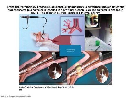 Bronchial thermoplasty procedure