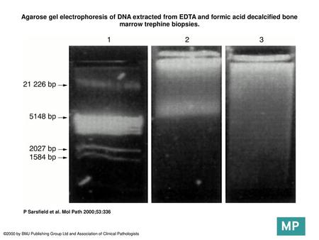 Agarose gel electrophoresis of DNA extracted from EDTA and formic acid decalcified bone marrow trephine biopsies. Agarose gel electrophoresis of DNA extracted.