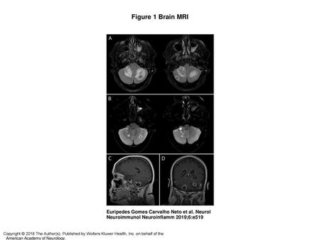 Figure 1 Brain MRI Brain MRI (A) Axial fluid-attenuated inversion-recovery images show perilesional edema in both cerebellar hemisphere and hypointense.