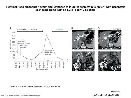 Treatment and diagnosis history, and response to targeted therapy, of a patient with pancreatic adenocarcinoma with an EGFR exon19 deletion. Treatment.