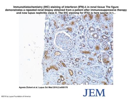 Immunohistochemistry (IHC) staining of interferon (IFN)-λ in renal tissue The figure demonstrates a repeated renal biopsy obtained from a patient after.