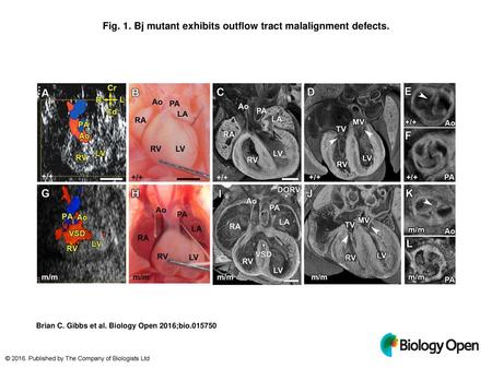 Fig. 1. Bj mutant exhibits outflow tract malalignment defects.