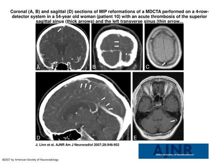 Coronal (A, B) and sagittal (D) sections of MIP reformations of a MDCTA performed on a 4-row-detector system in a 54-year old woman (patient 10) with an.