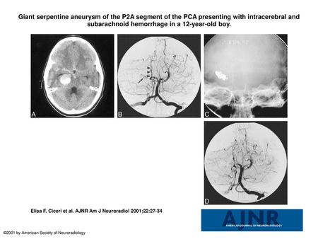 Giant serpentine aneurysm of the P2A segment of the PCA presenting with intracerebral and subarachnoid hemorrhage in a 12-year-old boy. Giant serpentine.