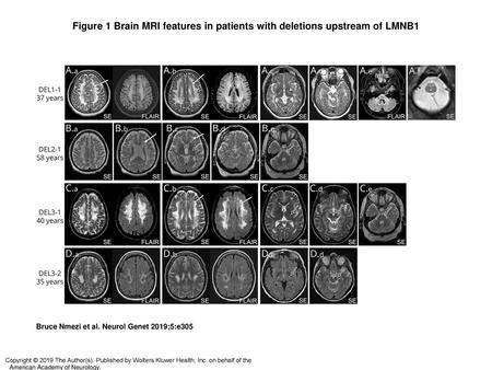 Figure 1 Brain MRI features in patients with deletions upstream of LMNB1 Brain MRI features in patients with deletions upstream of LMNB1 All images are.