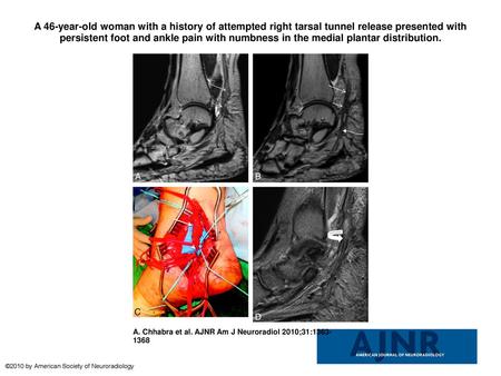 A 46-year-old woman with a history of attempted right tarsal tunnel release presented with persistent foot and ankle pain with numbness in the medial plantar.