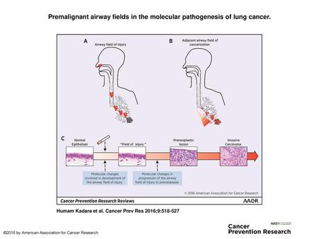 Premalignant airway fields in the molecular pathogenesis of lung cancer. Premalignant airway fields in the molecular pathogenesis of lung cancer. A, smoking.