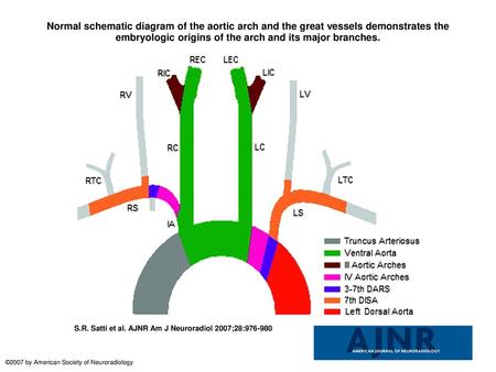 Normal schematic diagram of the aortic arch and the great vessels demonstrates the embryologic origins of the arch and its major branches. Normal schematic.