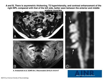 A and B, There is asymmetric thickening, T2 hyperintensity, and contrast enhancement of the right BPL compared with that of the left side, better seen.