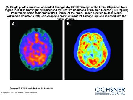 (A) Single photon emission computed tomography (SPECT) image of the brain. (Reprinted from Vigren P et al.11 Copyright 2014 licensed by Creative Commons.