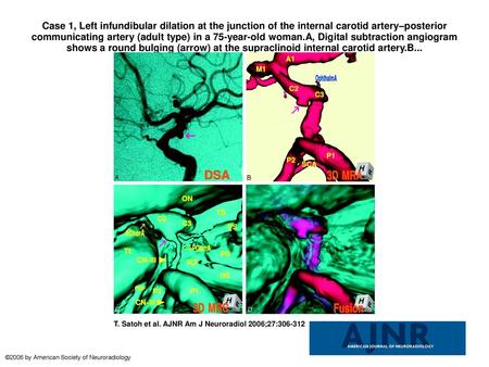 Case 1, Left infundibular dilation at the junction of the internal carotid artery–posterior communicating artery (adult type) in a 75-year-old woman.A,