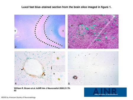 Luxol fast blue–stained section from the brain slice imaged in figure 1. Luxol fast blue–stained section from the brain slice imaged in figure 1. The outlined.