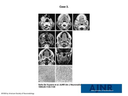 Case 3. Case 3. A–C, Axial contrast-enhanced CT scans show an enhancing soft-tissue mass (arrows, A) lying against the enlarged and enhancing right submandibular.