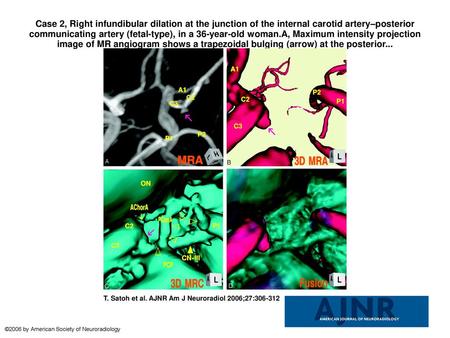 Case 2, Right infundibular dilation at the junction of the internal carotid artery–posterior communicating artery (fetal-type), in a 36-year-old woman.A,