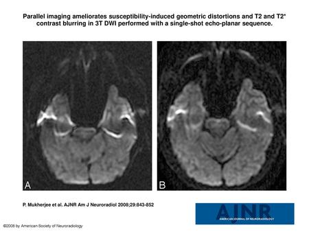 Parallel imaging ameliorates susceptibility-induced geometric distortions and T2 and T2* contrast blurring in 3T DWI performed with a single-shot echo-planar.