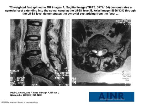 T2-weighted fast spin-echo MR images