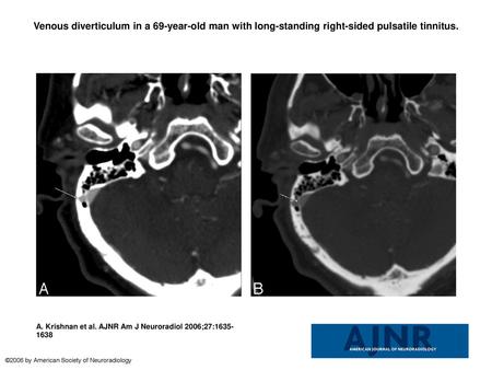 Venous diverticulum in a 69-year-old man with long-standing right-sided pulsatile tinnitus. Venous diverticulum in a 69-year-old man with long-standing.