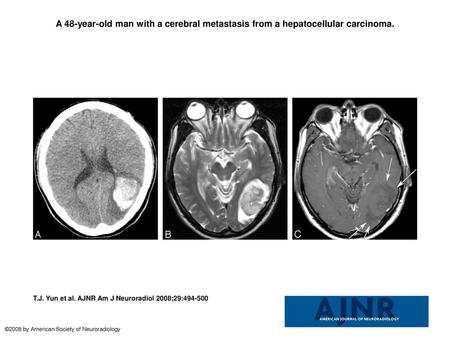 A 48-year-old man with a cerebral metastasis from a hepatocellular carcinoma. A 48-year-old man with a cerebral metastasis from a hepatocellular carcinoma.