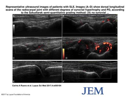 Representative ultrasound images of patients with SLE