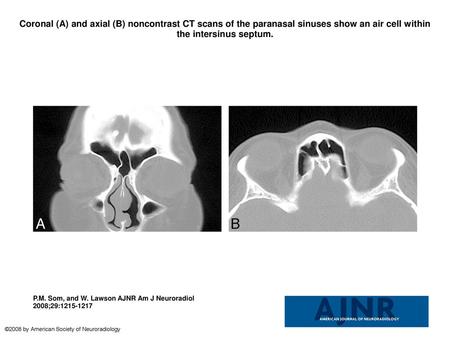 Coronal (A) and axial (B) noncontrast CT scans of the paranasal sinuses show an air cell within the intersinus septum. Coronal (A) and axial (B) noncontrast.