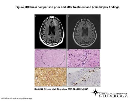 Figure MRI brain comparison prior and after treatment and brain biopsy findings MRI brain comparison prior and after treatment and brain biopsy findings.