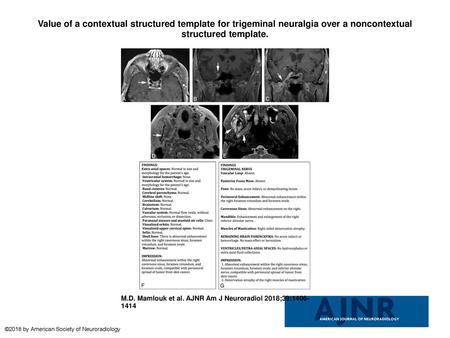 Value of a contextual structured template for trigeminal neuralgia over a noncontextual structured template. Value of a contextual structured template.