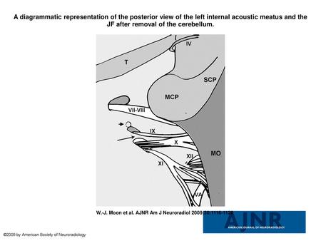 A diagrammatic representation of the posterior view of the left internal acoustic meatus and the JF after removal of the cerebellum. A diagrammatic representation.