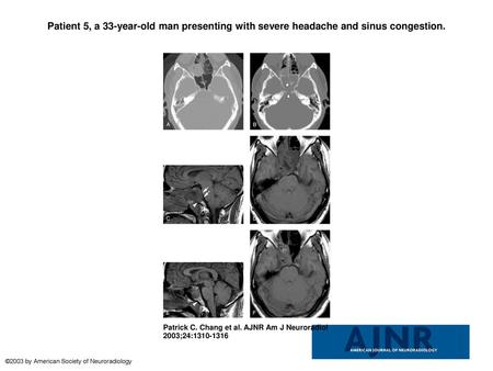 Patient 5, a 33-year-old man presenting with severe headache and sinus congestion. Patient 5, a 33-year-old man presenting with severe headache and sinus.