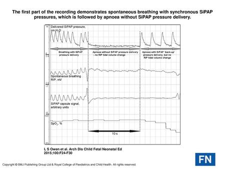 The first part of the recording demonstrates spontaneous breathing with synchronous SiPAP pressures, which is followed by apnoea without SiPAP pressure.