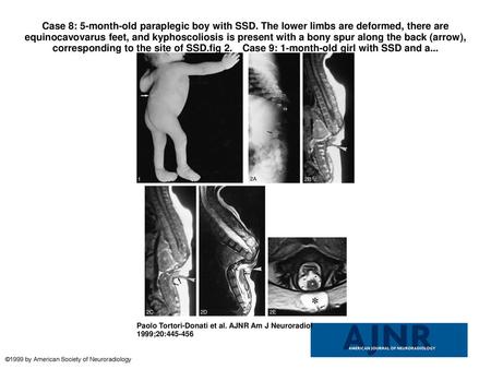 Case 8: 5-month-old paraplegic boy with SSD