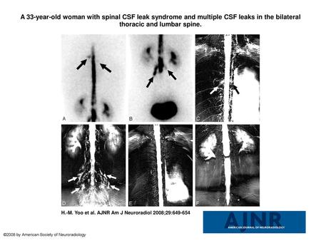 A 33-year-old woman with spinal CSF leak syndrome and multiple CSF leaks in the bilateral thoracic and lumbar spine. A 33-year-old woman with spinal CSF.