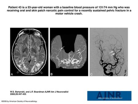 Patient 43 is a 53-year-old woman with a baseline blood pressure of 131/74 mm Hg who was receiving oral and skin patch narcotic pain control for a recently.