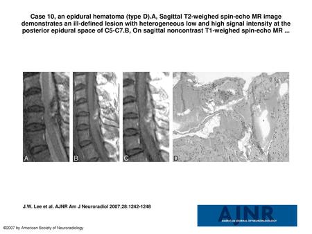 Case 10, an epidural hematoma (type D)