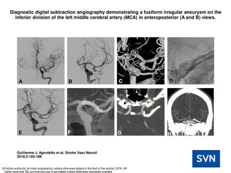 Diagnostic digital subtraction angiography demonstrating a fusiform irregular aneurysm on the inferior division of the left middle cerebral artery (MCA)