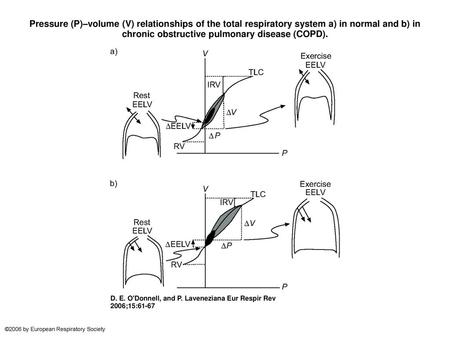 Pressure (P)–volume (V) relationships of the total respiratory system a) in normal and b) in chronic obstructive pulmonary disease (COPD). Pressure (P)–volume.