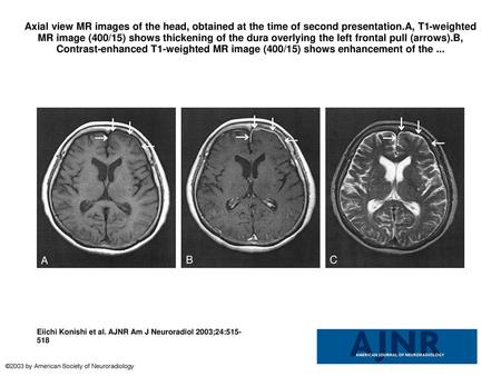 Axial view MR images of the head, obtained at the time of second presentation.A, T1-weighted MR image (400/15) shows thickening of the dura overlying the.