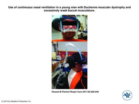 Use of continuous nasal ventilation in a young man with Duchenne muscular dystrophy and excessively weak buccal musculature. Use of continuous nasal ventilation.