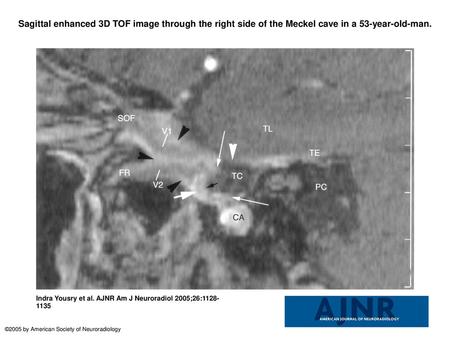 Sagittal enhanced 3D TOF image through the right side of the Meckel cave in a 53-year-old-man. Sagittal enhanced 3D TOF image through the right side of.